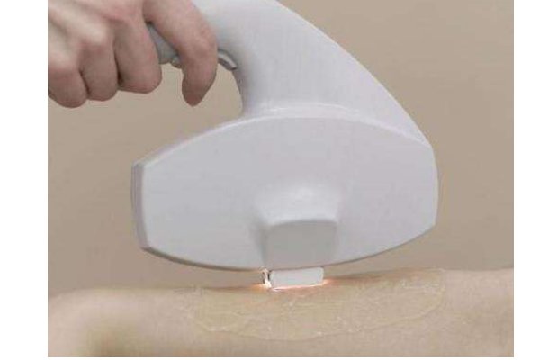 激光脱毛的价格多少