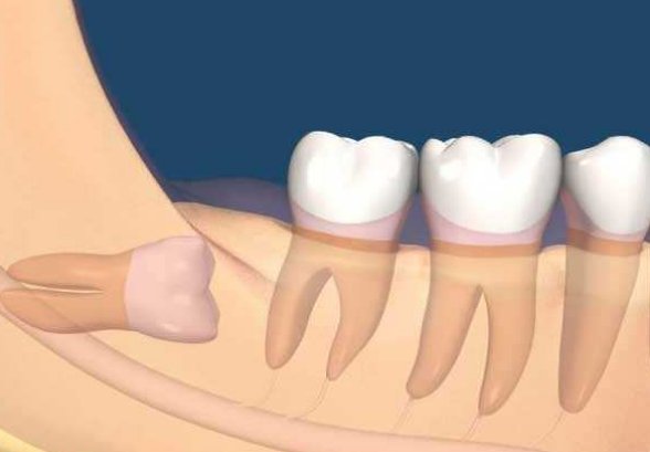 智齿是拔好还是不拔好