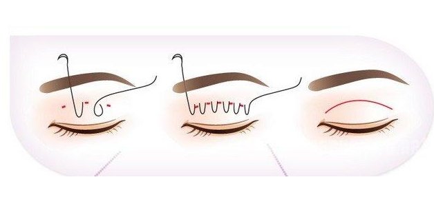 埋线是什么意思？