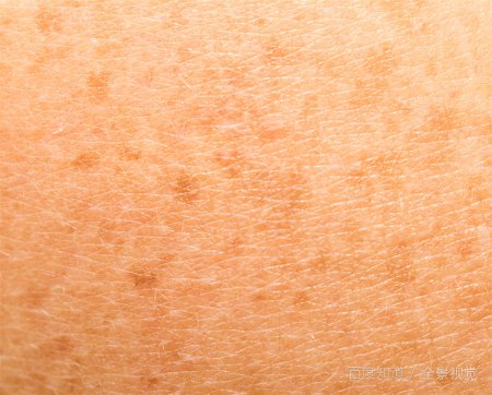 什么是黄褐斑？