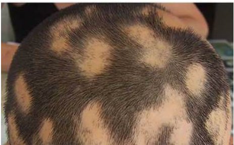 如何治疗斑秃？