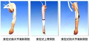 装假肢要注意什么?
