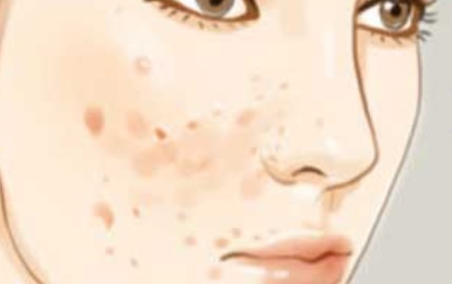 激光修复痘坑要多少费用