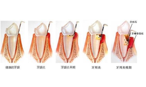 牙周袋是什么样子的？