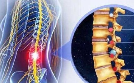 椎间盘膨出的治疗，有哪些方法呢？