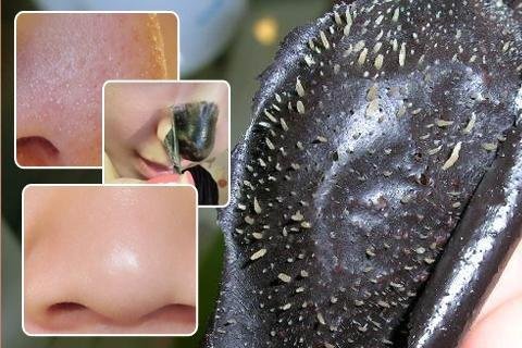 鼻子上有很多黑头怎么办？