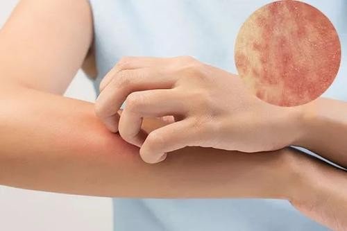 皮肤为什么会越抓越痒?