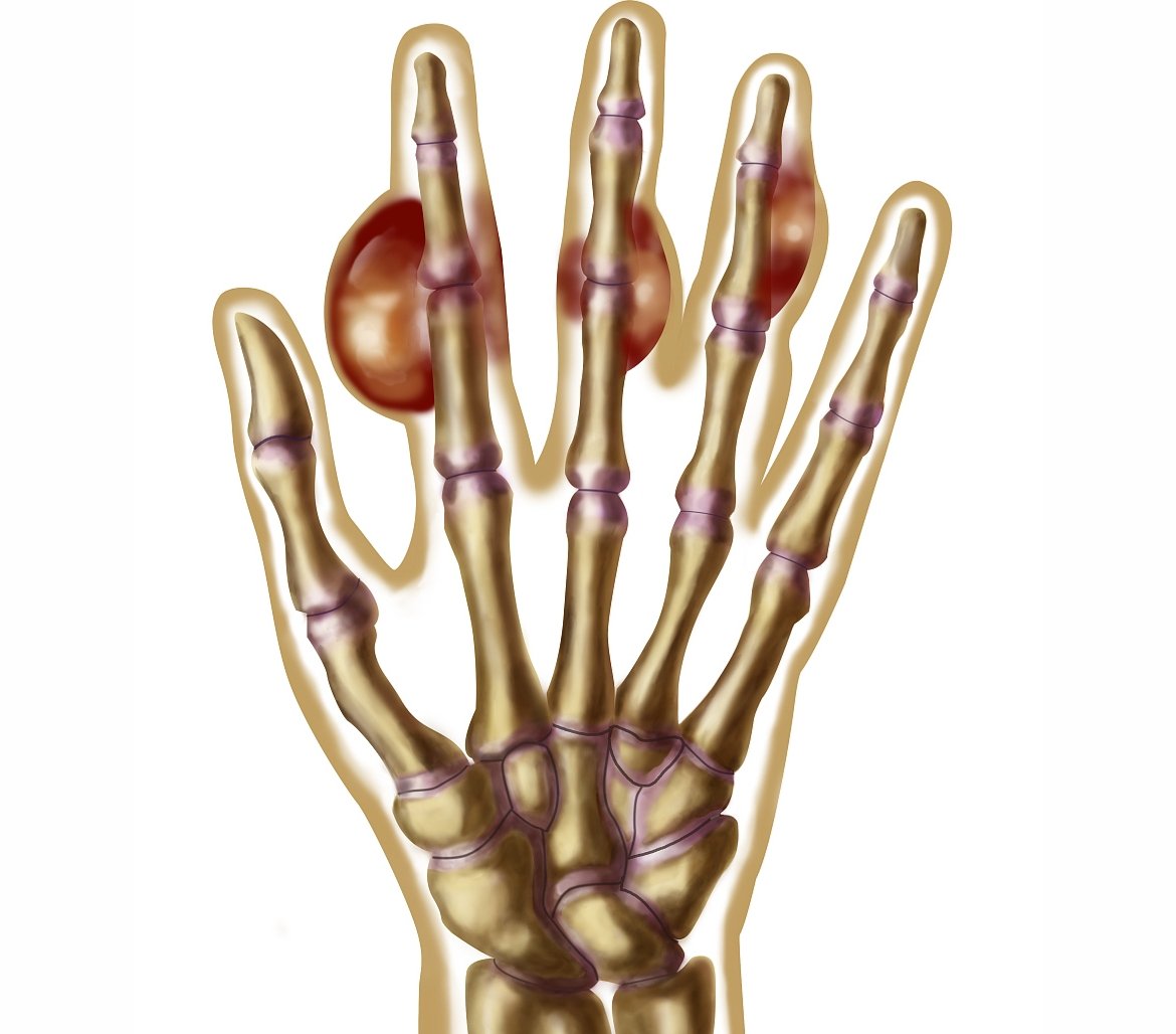 造成痛风的主要原因有哪些?