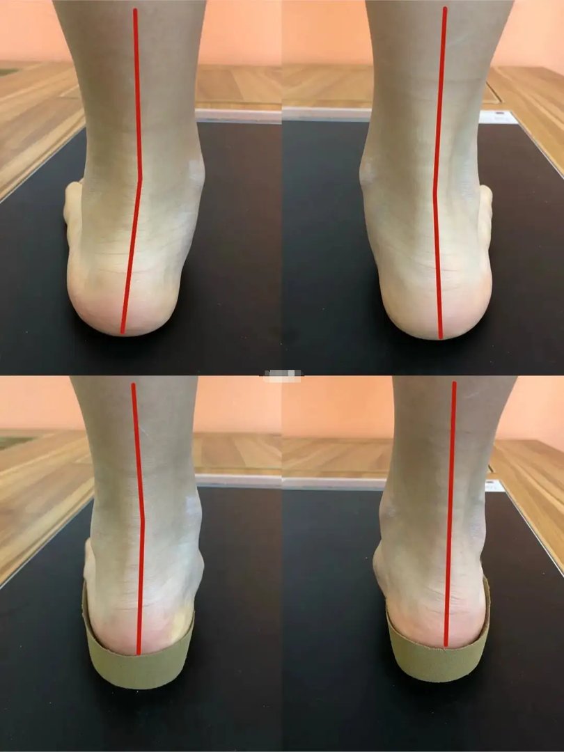 矫形鞋垫真的有用吗？