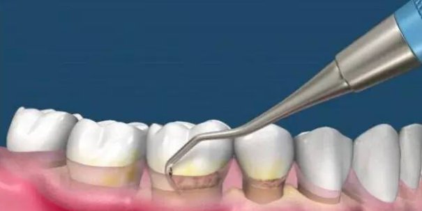 洗牙有什么好处和害处