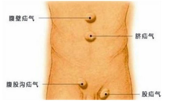 什么是小肠气？