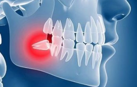 什么是冠周炎？