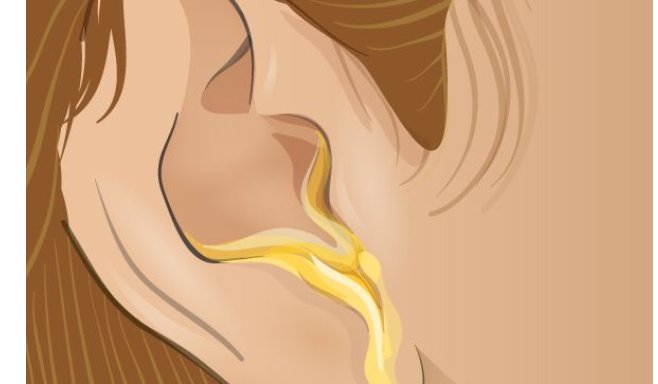 为什么我的耳屎是湿的？