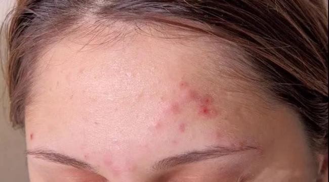 青春痘是什么样子的图片