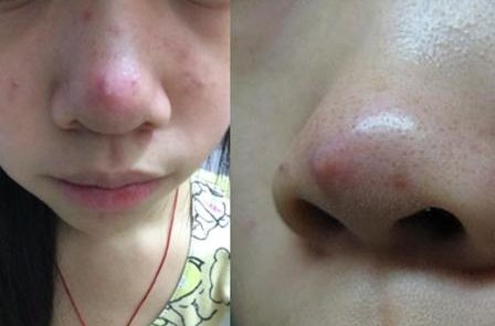 为什么我鼻子上经常长痘痘