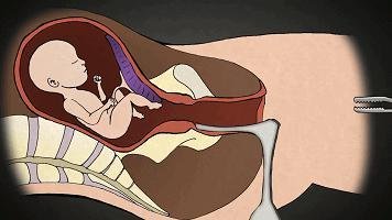 做完人流后注意事项？