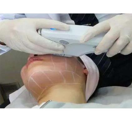 电波拉皮有没有副作用？