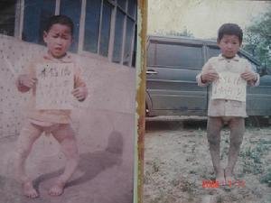 象腿病的症状体征