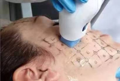 电波拉皮有没有副作用?