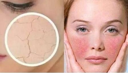 电波拉皮有没有副作用?