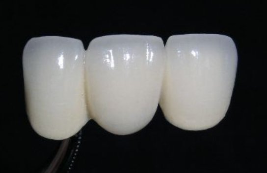 烤瓷牙一般可以用多久