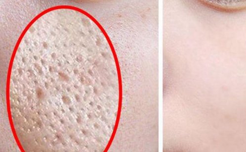 用什么东西可以快速收缩毛孔？