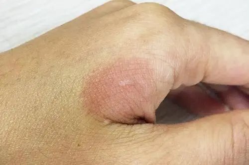 医生提醒红霉素软膏绝对不能长期使用，这是为何？