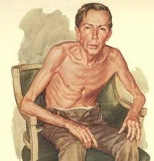 什么是肌无力？