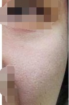 光子嫩肤怎么样