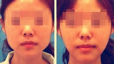 瘦脸针botox一般多少钱