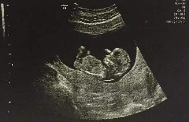 做B超，涂在肚子上黏糊糊的液体到底是什么？