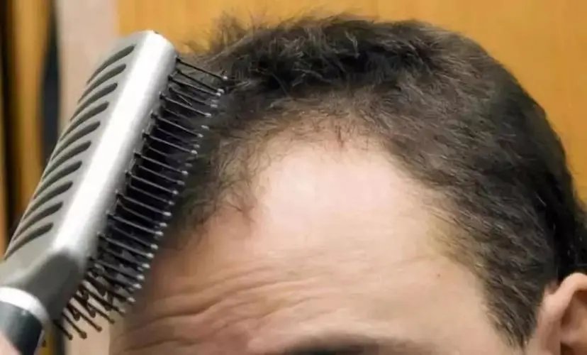 第一批00后开始脱发了,导致头秃的主要因素有哪些?