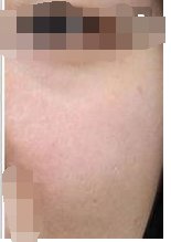 光子嫩肤怎么样