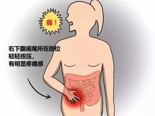 阑尾炎是因为什么原因引起的呢?