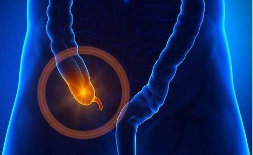 阑尾炎是因为什么原因引起的呢?