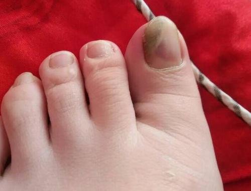 脚趾甲里有淤血怎么办?大概等多久才散??