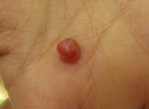 成人手指上长了血管瘤怎么办