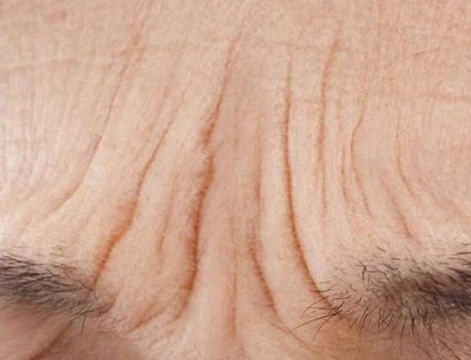 什么方法去除眉间纹好?