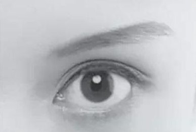 双眼皮平行和扇形的区别