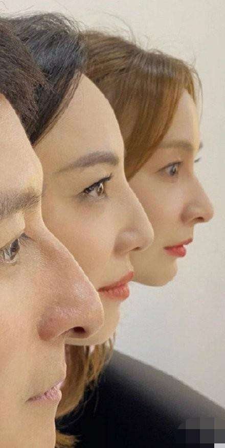 李维嘉吴昕同款鼻子，这种鼻型的人多吗？