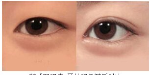 开外眼角前后对比照的效果怎样
