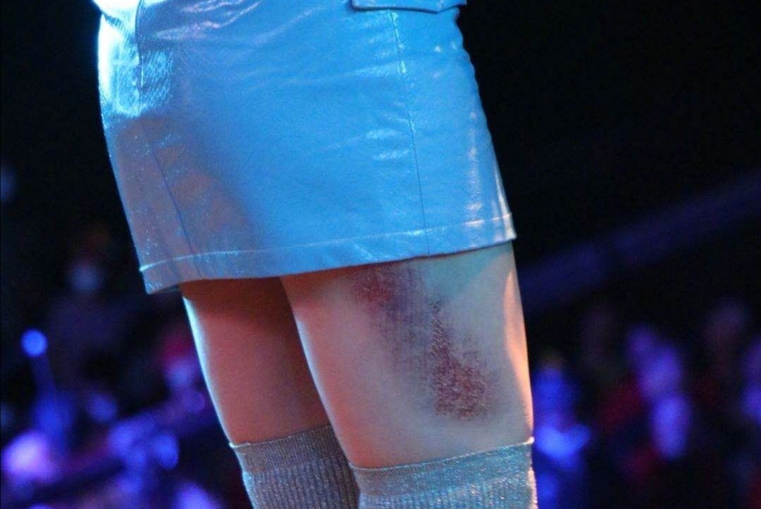 黄龄在演唱途中不慎摔下舞台，具体是什么情况？