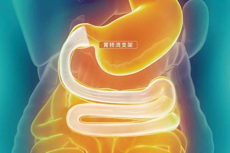 糖尿病人如何运动