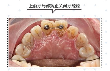 牙缝太大,如何修复?
