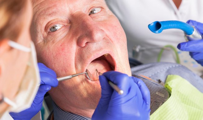 牙结石怎么去除？