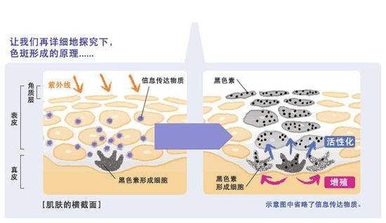 怎么治疗脸上的雀斑