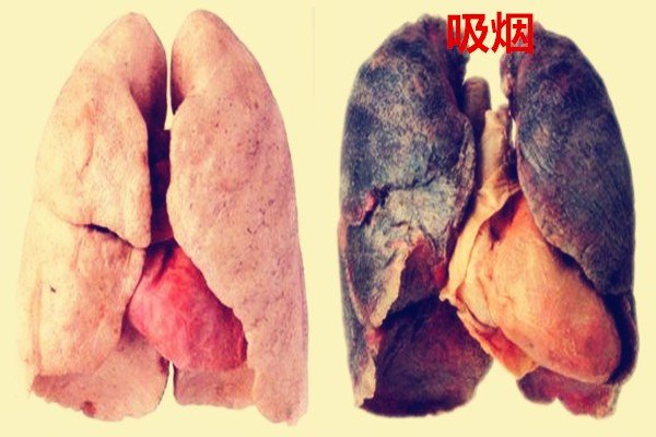 吸烟者的肺(图片)