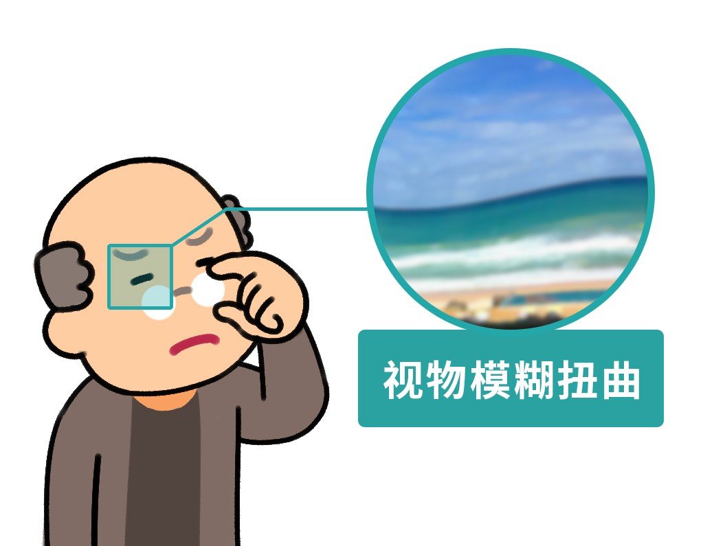 什么是眼黄斑变性?